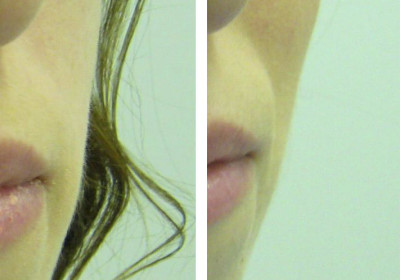 Armonización / Recuperación de volúmenes faciales (bioplastia facial)