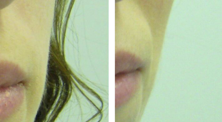 Armonización / Recuperación de volúmenes faciales (bioplastia facial)